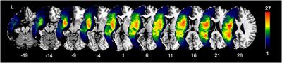 White Matter Correlates of Auditory Comprehension Outcomes in Chronic Post-Stroke Aphasia